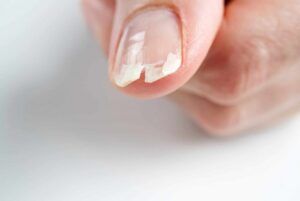 ongle-casse-reparer
